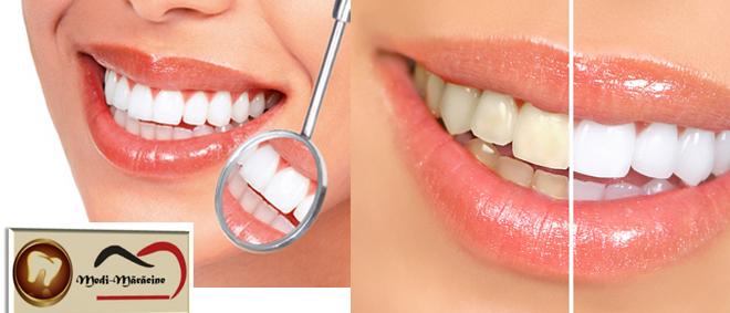 PACHET ALBIRE DINTI (albire + fluorizare ambele arcade + airflow și periaj dentar profesional) cudoar 69 RON la clinica de stomatologie MEDI - MARACINE din PLOIESTI!